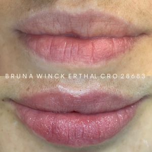 ASSIMETRIA LABIAL